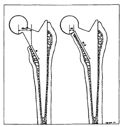 Figure 1. Illustration of the Freeman hip prosthesis with neck
resected and neck retained. figure 1