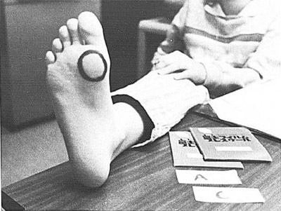 Figure 2. Circle on first metatarsal head. figure 2