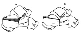 Biomechanics Fig. 1. Schematic description of the imposed calcaneal fracture showing (A) the primary and secondary fracture line and the resected wedge (shaded area); (B) the resulting shape of the calcaneus.