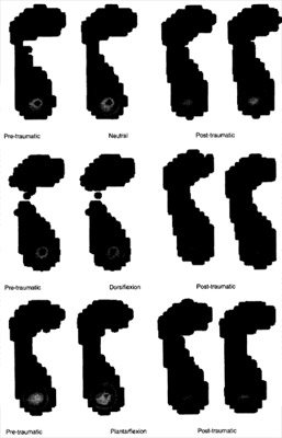 Biomechanics Fig. 4. Example of plantar pressure measurements (Foot # 3) with the pre-traumatic (left) and posttraumatic calcaneus (right) demonstrating the load shift to the mid-foot and lateral forefoot region. No marked differences are seen between the neutral position, 10° dorsiflexion, 10° plantarflexion. Two repeated trials in each condition are shown to demonstrate the repeatability.