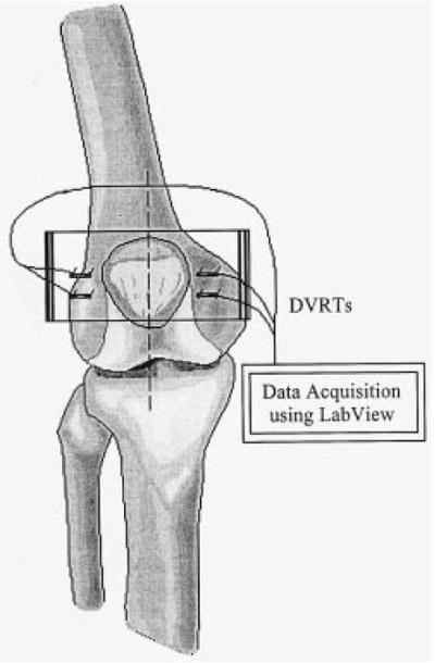 Figure 2. Diagram showing DVRT placement and data acquisition.
Diagram is not to scale. figure 2
