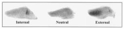 Figure 3. Typical tibial rotation contact pressures taken at 30º KFA. figure 3