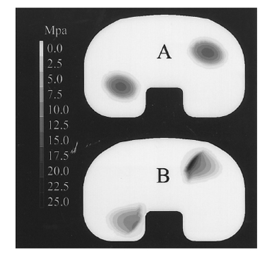 Fig 5A–B. Contour map of contact stresses with the fig5