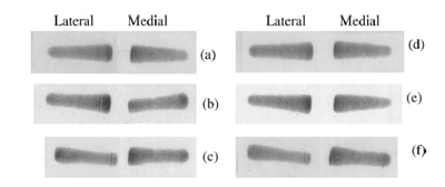 The typical results of contact pressure distribution measured by Fuji prescale sensitive film