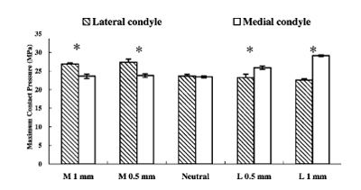 MCPs in the medial (M) and lateral (L) maltranslation (mm) of
femoral component relative to the normal contact alignment at 0