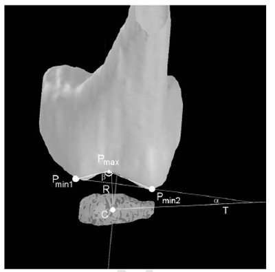 Fig. 3. Patellar-based coordinate system (transversal view) figure 3