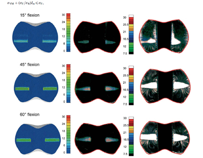 Fig. 5. Left column: contact pressure maps on the inferior surface of the PE insert at figure 5