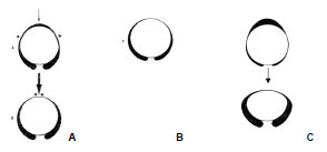 Biomechanics Abb. 2.14: Formen des Acetabulum, Transversalschnitt; A geringfügig inkongruentes Hüftgelenk beim jugendlichen Hund, erst unter Belastung wird auch das Pfannendach zur Artikulationsfläche; B Acetabulumform eines adulten Hundes; C Entwicklung der Hüftgelenkdysplasie; aus der inkongruenten jugendlichen Acetabulumform entwickelt sich die dysplastische Form durch die dauerhafte Nicht-Belastung des Pfannendachs; * = druckbelastete Stellen (Abb. nach Badoux und Hoogeveen, 1976).