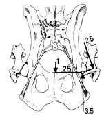 Biomechanics Abb. 2.9: Darstellung der Hebelarme des Hüftgelenks, die Prieur zur Berechnung der Größe der Belastung im Hüftgelenk verwendet; sie haben einen gemeinsamen Drehpunkt im Femurkopfzentrum, die Kraft, die auf den Femurkopf einwirkt entspricht dem 3- bis 4fachen Körpergewicht (Abb. nach Prieur, 1980).