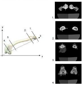 Biomechanics Abb. 3.10: Schnittebenen durch das Os femoris. 1. Femurkopf-Aufnahme, 2. Proximale Schaft-Aufnahme in Höhe des Trochanter minor, 3. Distale Schaft-Aufnahme proximal der Tuberostias supracondylaris, 4. Kondylen-Aufnahme.