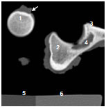 Biomechanics Abb. 3.6: CT-Schnittbild durch Femurkopf (links) und Acetabulum (rechts). Am unteren Bildrand ist das Phantom zu sehen. 1 Fovea capitis mit Lig. capitis ossis femoris (Pfeil), 2 Pfannendach, 3 Ventralrand Acetabulum, 4 Fossa acetabuli mit Inc. acetabuli, 5 Phantom, Wasseräquivalent, 6 Phantom, Spongiosaäquivalent.