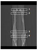 Biomechanics Abb. 3.8: Topogramm eines linken und rechten Gliedmaßenpräparats. An den Ossa femoris sind die verschiedenen Schnittebenen als ROIs 1-4 markiert.