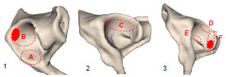 Biomechanics Abb. 4.1: Schematische Darstellung der Lokalisation der Knorpelschäden A-F in einem linken Acetabulum, Ansicht von 1 kaudolateral, 2 lateral, 3 kraniolateral; A Schäden am Vorderhorn, B an der Kraniodorsalfläche, C im Pfannendach, D am Übergang zum Hinterhorn dorsal, E ventral, F Schäden am Hinterhorn; tief angefärbte Bereiche bezeichnen die Stellen der häufigsten Lokalisation.