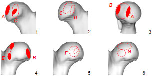 Biomechanics Abb. 4.2: Schematische Darstellung der Lokalisation der Knorpelschäden A-G am Femurkopf; 1-2 Ansicht von kranial, 3 Ansicht von medial, 4-6 Ansicht von kaudal; A,C,D Schäden an der Kranialfläche, A, B am Rand der Fovea capitis, E-G an der Kaudalfläche; tief angefärbte Bereiche stellen Orte häufiger, massiver Schädigungen dar.