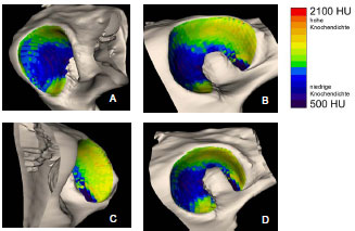 Biomechanics Abb. 4.20: Verteilungsmuster der subchondralen Knochendichte im Acetabulum eines ca. 2 Jahre alten, männlichen Mischlingshundes; A Kranialfläche, B Dorsalfläche, C Kaudalfläche, D gesamte Gelenkfläche im Überblick