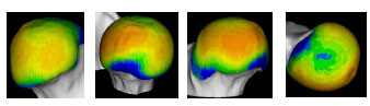 Biomechanics Abb. 4.31: Darstellung der mittleren Knochendichte der Gruppe 'mittleres Alter'.