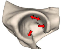 Biomechanics Abb. 5.3: Schematische Darstellung des Aufbiegens des Acetabulum unter Belastung.