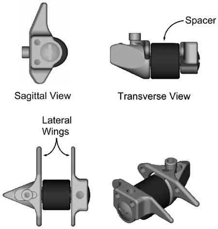 Figure 1. A schematic of the X STOP interspinous implant. fig 1