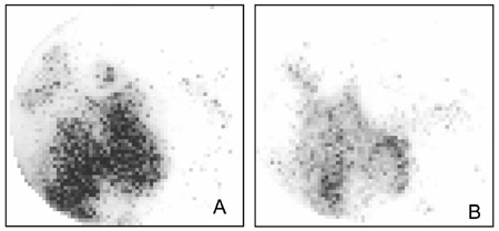 Figure 3. Representative loading patterns of a facet of (A) an intact motion segment fig 3