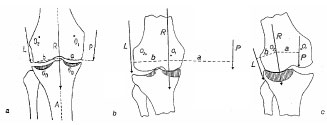 Biomechanics Abb. 8: Spannungsdiagramme im humanen Tibiaplateau bei (a) Normalpersonen, (b) Genu varum, (c) Genu valgum (Maquet et al., 1975)
