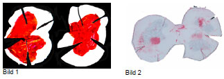 Biomechanics Abb. 27: Vergleich der Kontaktflächen in der Belastungsstufe 100%, 314N (W2-26, rechte Tibia) Bild 1: Silikonabdruck Bild 2: Druckfilm (Fuji SLow)