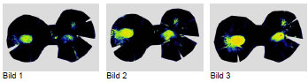 Biomechanics Abb. 30: Falschfarbendarstellung der selben Kontaktflächen bei den gleichen Belastungsstufen (W2-26, rechts) Bild 1: Kontaktfläche in der Belastungsstufe 150%, 471N; Bild 2: Kontaktfläche in der Belastungsstufe 200%, 628N; Bild 3: Kontaktfläche in der Belastungsstufe 250%, 785N