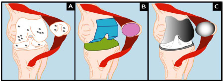 Biomechanics Figure 2-1: TKR Procedure: Degenerative joint disease leads to the destruction of articular cartilage on femur, tibia, and/or patella (A). Diseased articular cartilage is removed using a bone saw and anatomical jigs (B). Metal femoral component, metal tray and polyethylene insert (tibial component), and polyethylene patellar button are cemented or press-fit to subchondral bone (C).