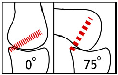 Biomechanics Figure 2-3: Schematic demonstrating the functional behavior of the posterior cruciate ligament. In extension the fibers are predominantly lax, but as the knee flexes the fibers become stretched. This tension is thought to cause the posterior translation of the femur known as 'rollback'.