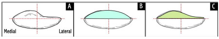 Biomechanics Figure 2-5: Superior schematic view of patella (A), symmetric dome implant (B), and anatomical or asymmetric implant (C). Median crest of patella is 5.5 mm medial to red midline. The amount of residual bone after cutting is typically between 10-15mm.