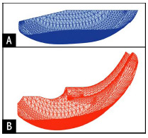 Biomechanics Figure 4-1: Sagittal profiles of the two tibial inserts simulated within this study: (A) condylar and (B) ultraconforming