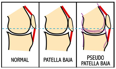 Biomechanics Figure 5-1: Schematic illustrating the physical differences between the true presentation of patella baja and the pseudo patella baja condition. True patella baja has a shortening of the patellar tendon, while in the pseudo patella baja condition the patellar tendon length remains consistent. Note that, the superior-inferior position of the patella relative to the horizontal reference (dashed blue line) remains consistent between the normal and pseudo patella baja conditions. The dashed purple lines represent joint line elevation following TKR.