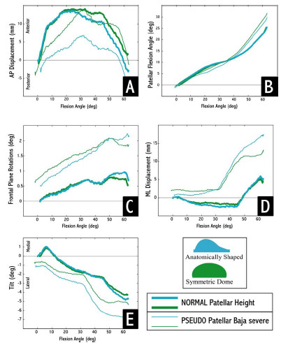 Biomechanics Figure 5-10: For normal patellar height, both patellar designs exhibited similar motion patterns, but for pseudo patella baja conditions their motions differed.