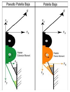 Biomechanics Figure 5-11: Due the angle of the patellar tendon with respect to the long axis of the tibia, a patella baja condition creates a patellar flexion moment. The black patella represents normal patellar height.