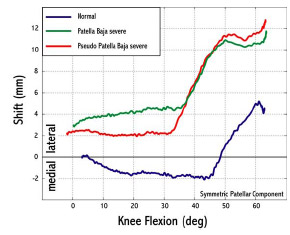 Biomechanics Figure 5-6: Any reduction of patellar height increased patellar lateral shift from normal conditions for flexion angles greater than 30º. For normal conditions the patella tracked medially for 2 mm before tracking laterally for 7 mm after 45º flexion.