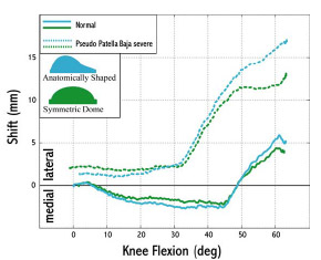 Biomechanics Figure 5-7: After 50° flexion the anatomical patellar component was more laterally displaced as compared to the symmetric patellar implant.