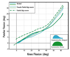 Biomechanics Figure 5-8: For pseudo patellar baja conditions the patellar flexion angle was greater than normal patellar height conditions at flexion angles 45º and higher. Patellar flexion angle was greater for all flexion angles for patella baja conditions as opposed to pseudo patella baja conditions.