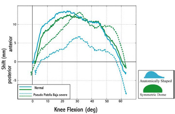Biomechanics Figure 5-9: Anterior-posterior displacement of the patellar component was substantially reduced for pseudo patella baja conditions with an anatomical patellar design.
