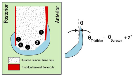 Biomechanics Figure 6-1: The Triathlon CR design (Stryker Orthopaedics; Mahwah, NJ) required a 2º greater femoral anterior cut than the Duracon CR design (Stryker Orthopaedics; Mahwah, NJ). Cut plane designations are represented by a black circle with number.