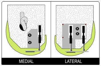 Biomechanics Figure 6-3: Schematic illustrating the mounting of DVRTs on foam block. Aluminum mounting plates were glued in the same location on each block. The DVRT mounting plate could then be bolted to each mounting plate, securing the DVRT to the foam block. Divot holes (red dots) were machined into the lateral plate to establish a block-fixed coordinate system. A knot was tied into the climbing rope used to simulate the posterior cruciate ligament.