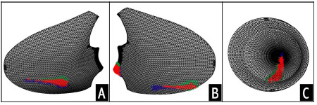 Biomechanics Figure A-4: Computed contact areas on the lateral (A) and medial (B) tibial condyle and the patellar component (C). Blue areas signify contact area from set of registration matrices, green areas signify contact area from the other set of registration matrices, while red area represent overlapping contact area. On average the overlapping area represented more than 75% of the total contact area indicating good agreement between sets of registration transformations.
