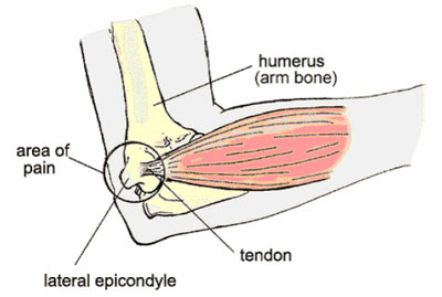 Figure 1. Anatomical diagram of lateral epicondylitis (Source: med.umich.edu) figure 1