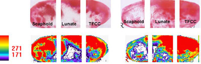 Figure 1. Fuji pressure sensitive films and color conversion in intact wrist and after four-corner fusion.