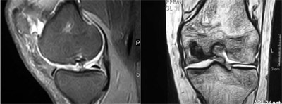 Figure 1. Preoperative magnetic resonance imaging scan of a deep osteochondral lesion. figure 1