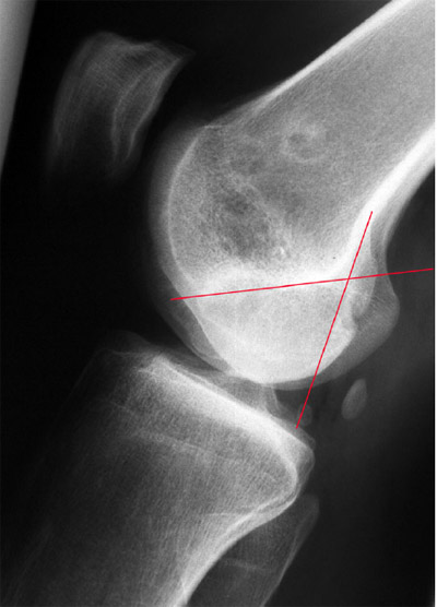 Figure 11. Partial remodelling of the posterior femoral condyle:. figure 11