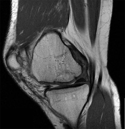 Figure 12. Magnetic resonance image after posterior condyle transfer. figure 12