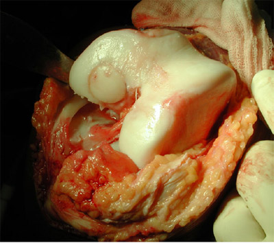 Figure 4. Large osteochondral autogenous Lpalarcgeed o isnt ethoec hporenpdararel adu dtoegfeecnto suitse transplantation system graft press-fit placed in the prepared defect site. figure 4