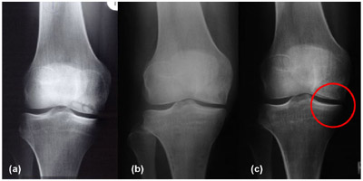 Figure 8. Progression of osteoarthritis in X-ray examinations. figure 8