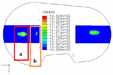 Fig. 10 – Contact areas calculated by FEA: a) “bearing contact area” b)“medio-lateral stabilization contact area” fig 10