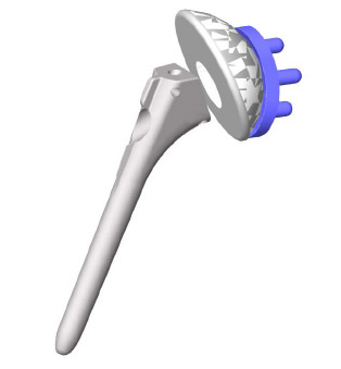 Biomechanics Figure 2 Typical total shoulder arthroplasty components.