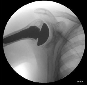 Biomechanics Figure 10 Typical fluoroscopic image of the shoulder with TSA.